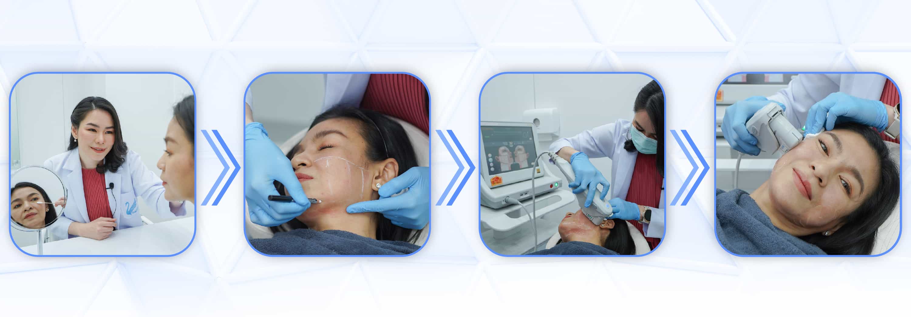 Ulthera SPT ขั้นตอนการรักษา