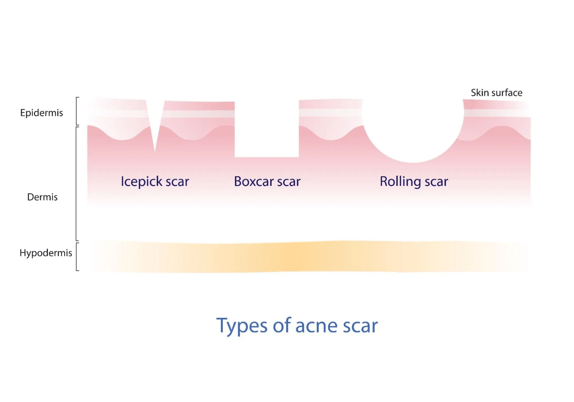 Exosome treatment in acne scar