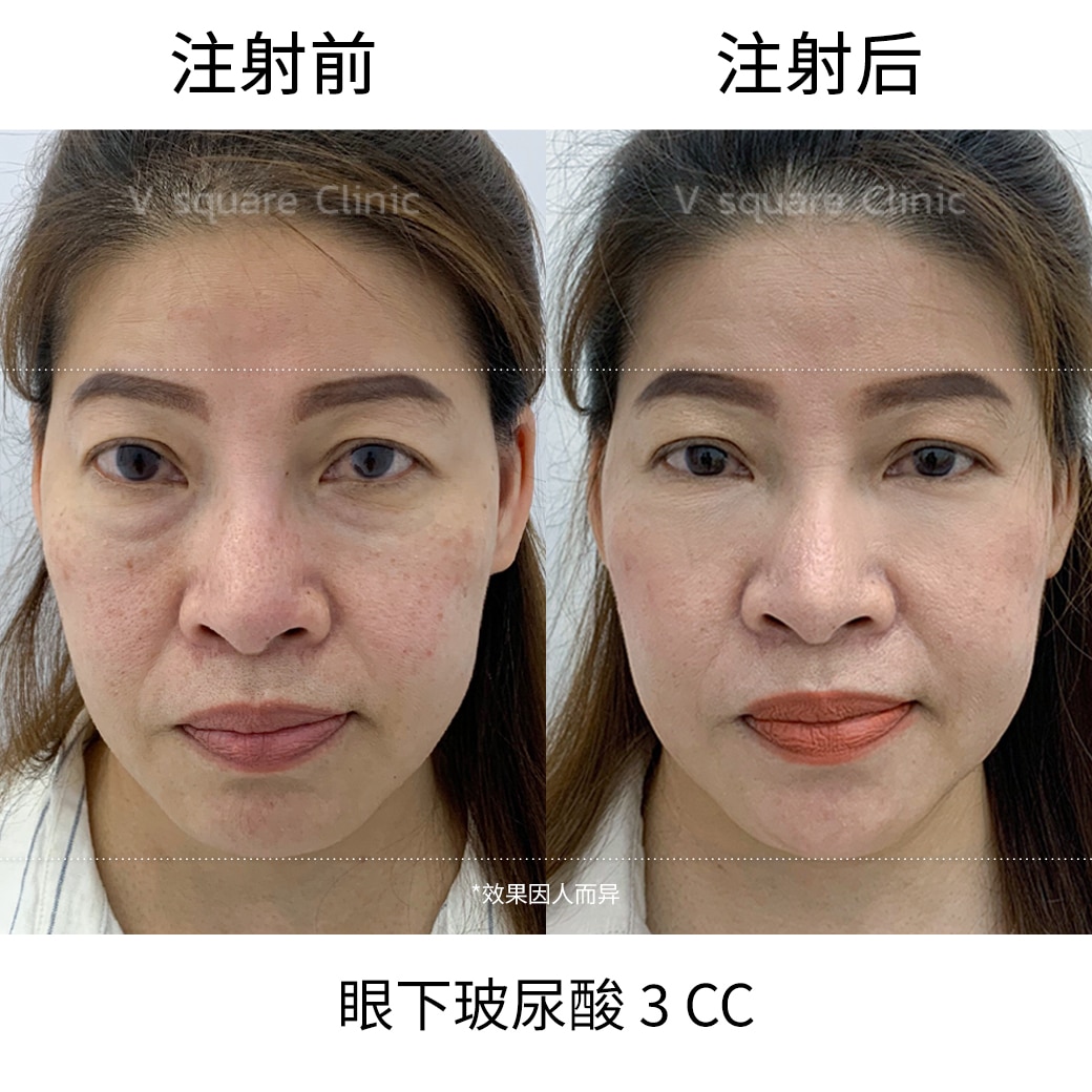 Filler Review_คุณส้ม