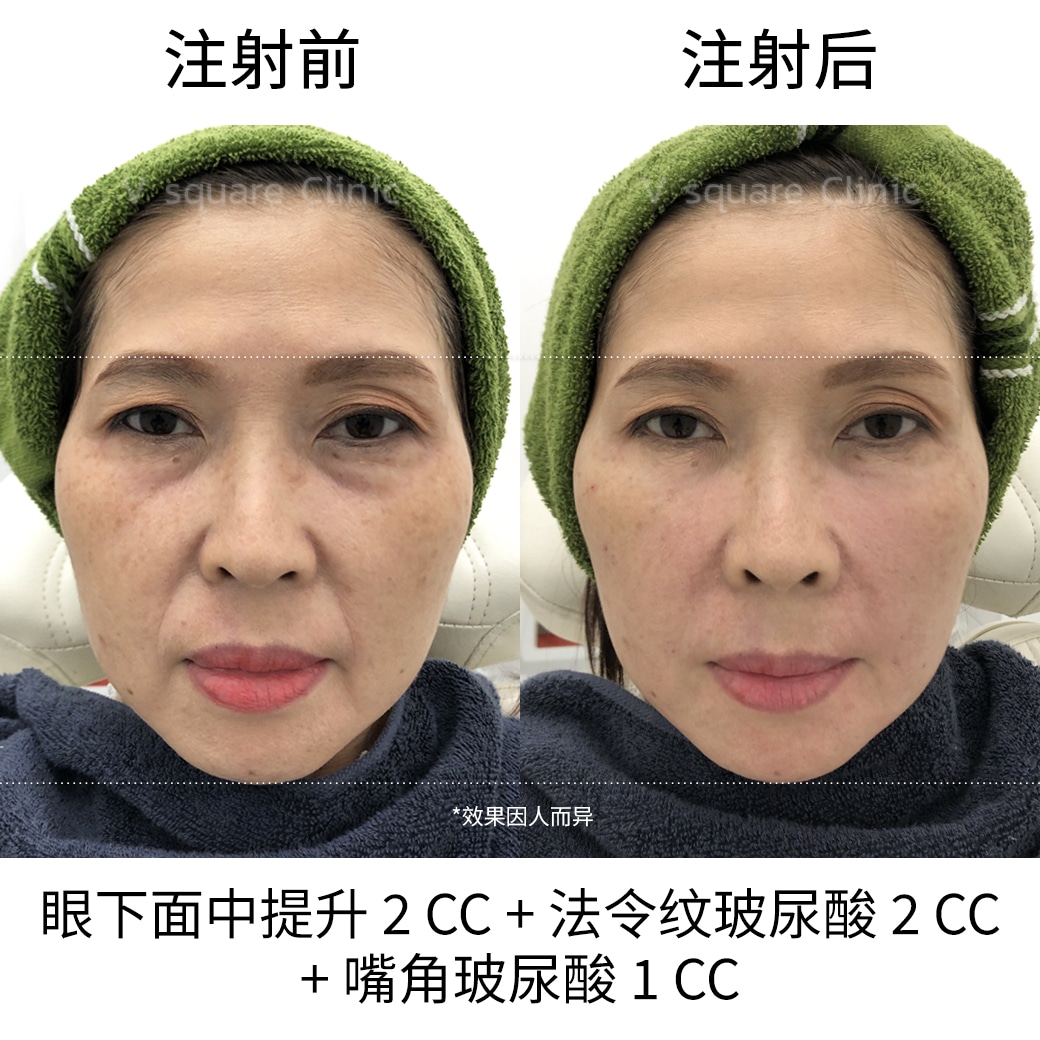 Filler Review_เคสรีวิว