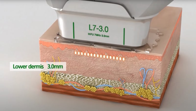 Hifu handpiece 3.0 mm