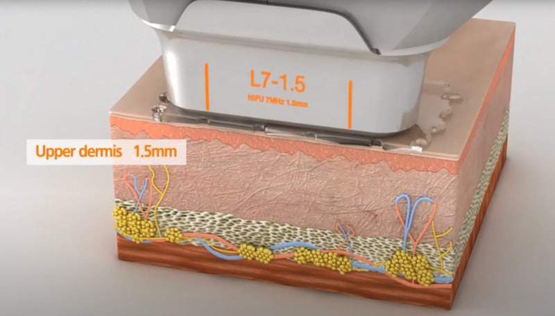 Hifu handpiece1.5-2.0 mm