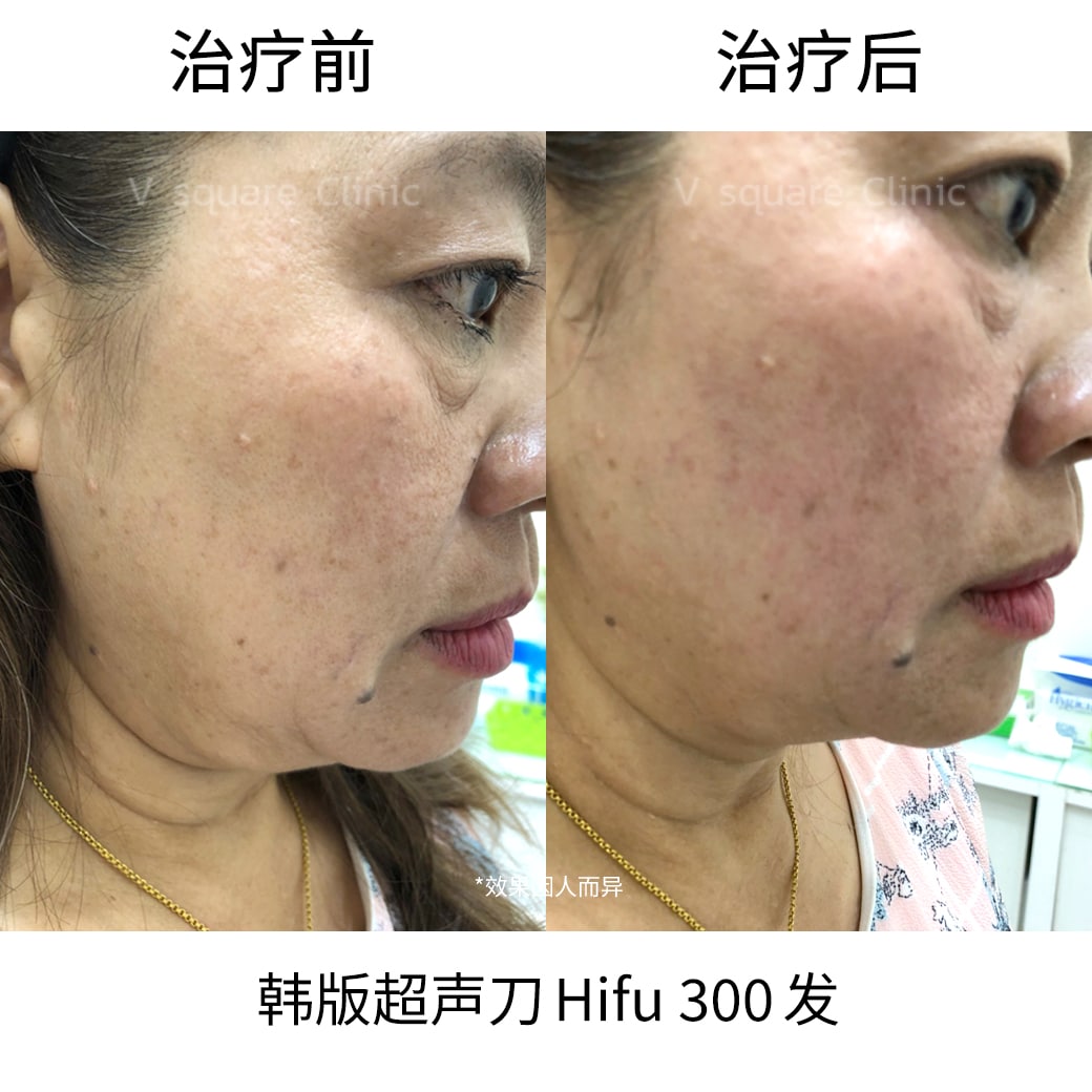 Hifu review under chin