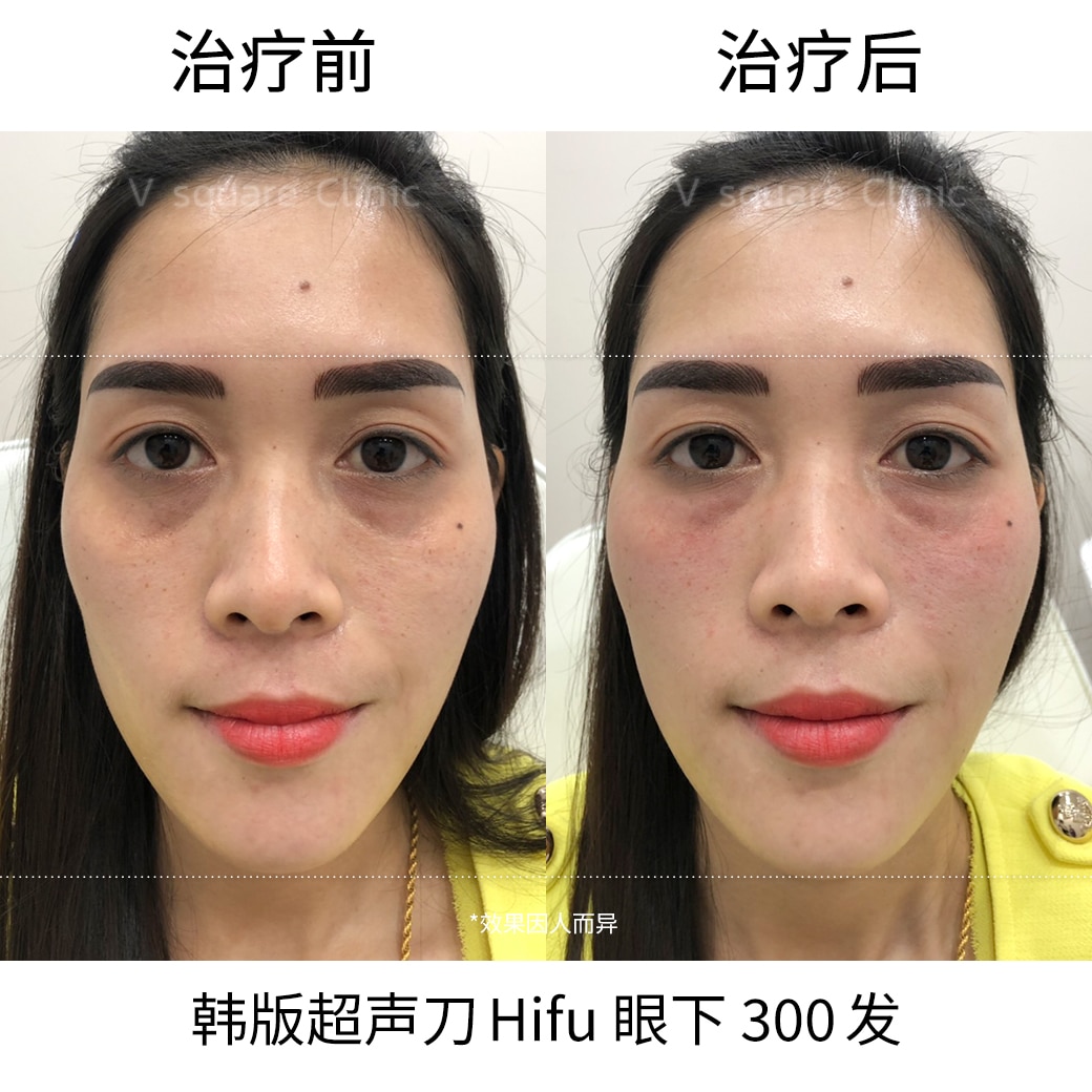 Hifu under eye review_รหัสงานR0077
