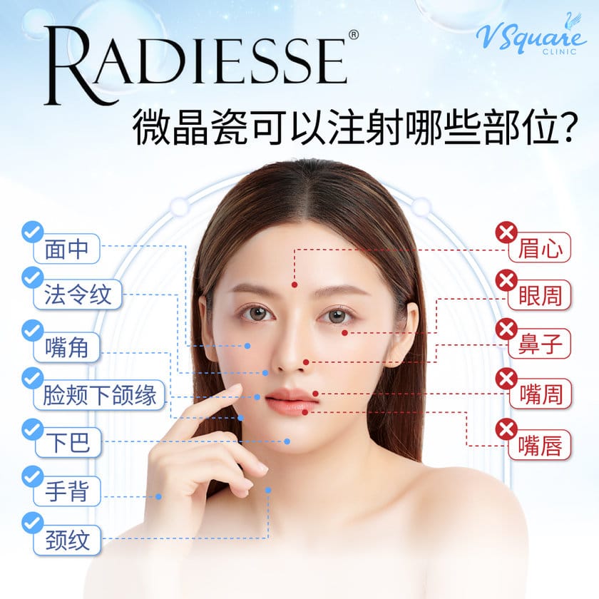 Radiesse Filler injection area