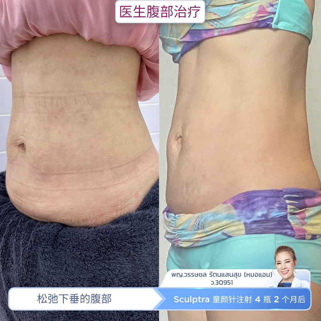 Review Sculptra Body