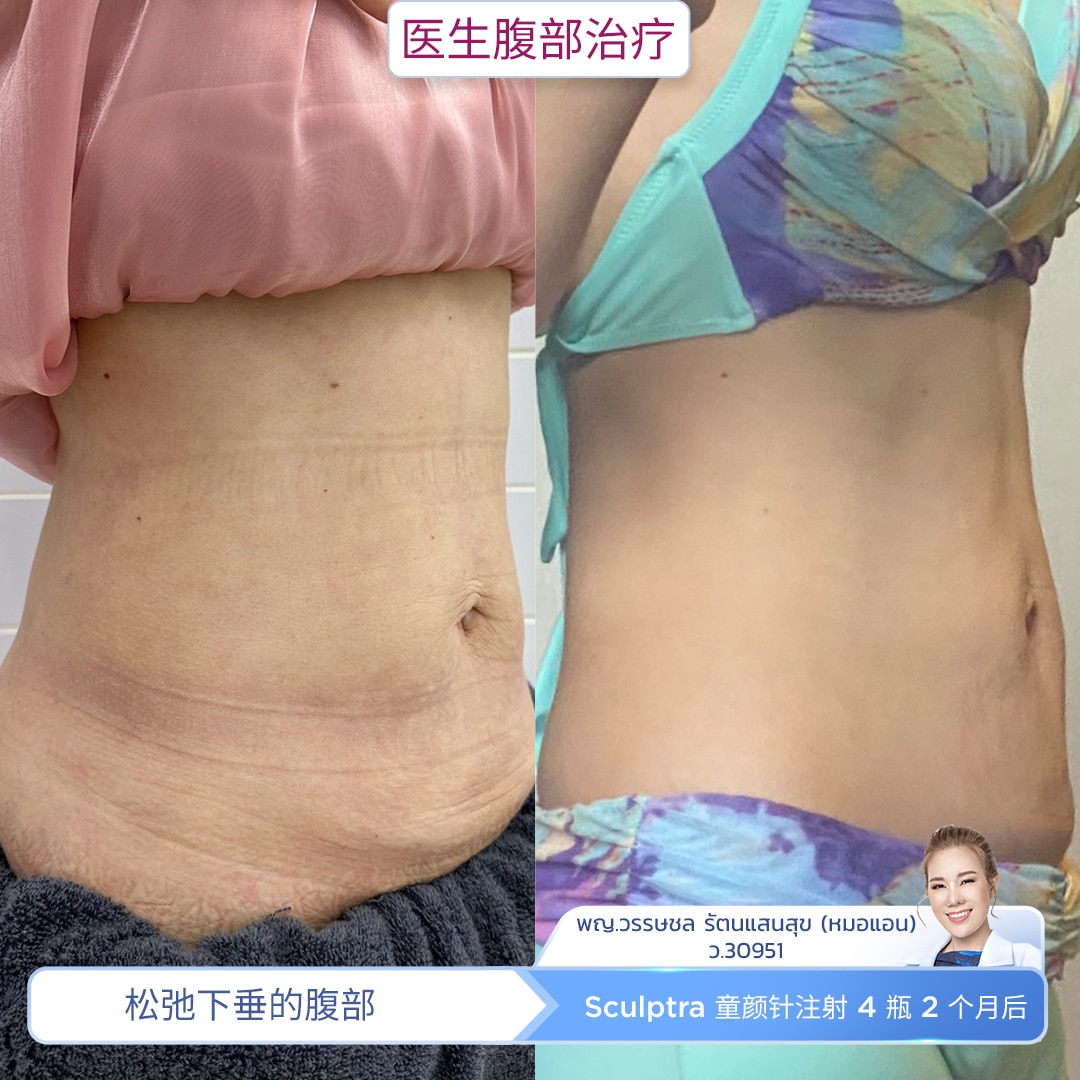 Review Sculptra Body(1)