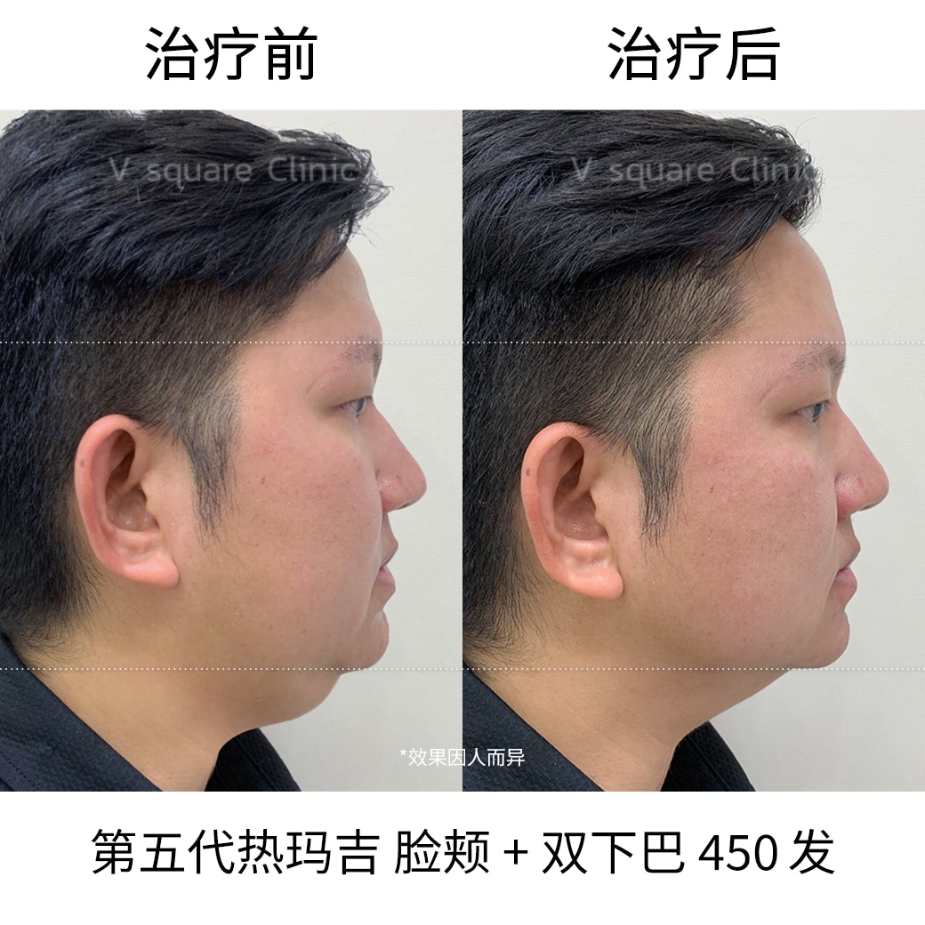 Review Thermage flx_พี่ต๊อก