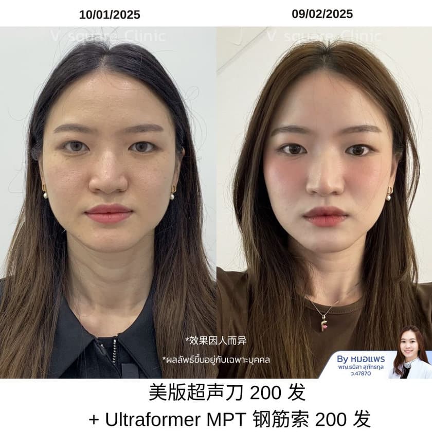 Review Ulthera 200line_ฟิว