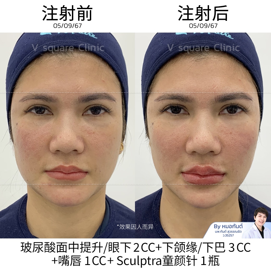 Sculptra Review_ทนายนิด้า