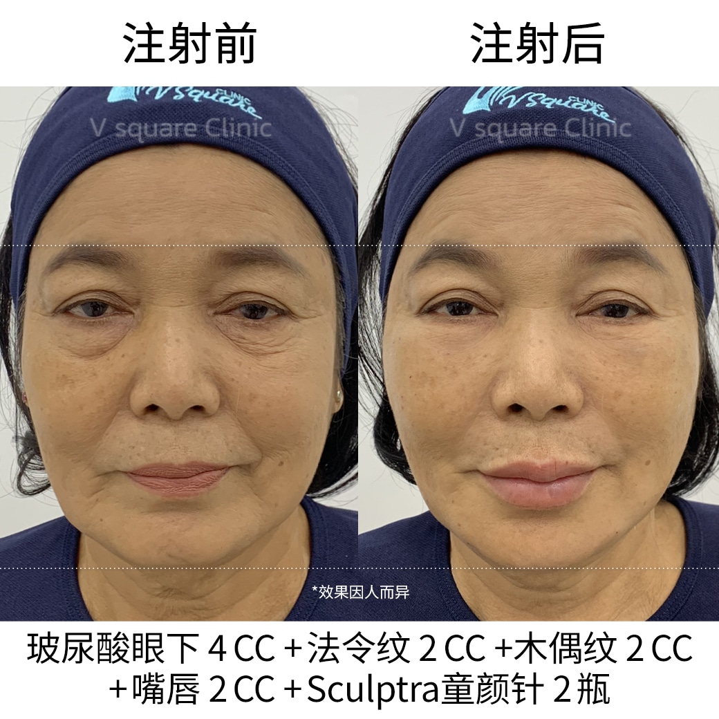 Sculptra Review_แม่แรม