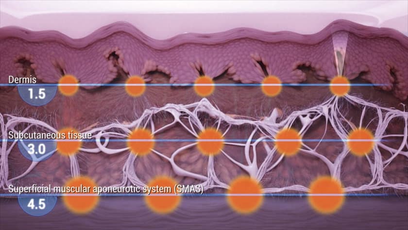 Ulthera energy can reach SMAS