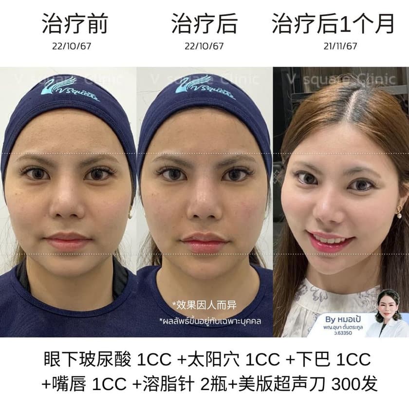 Ulthera review_น้องเตย (หน้าเรียว)