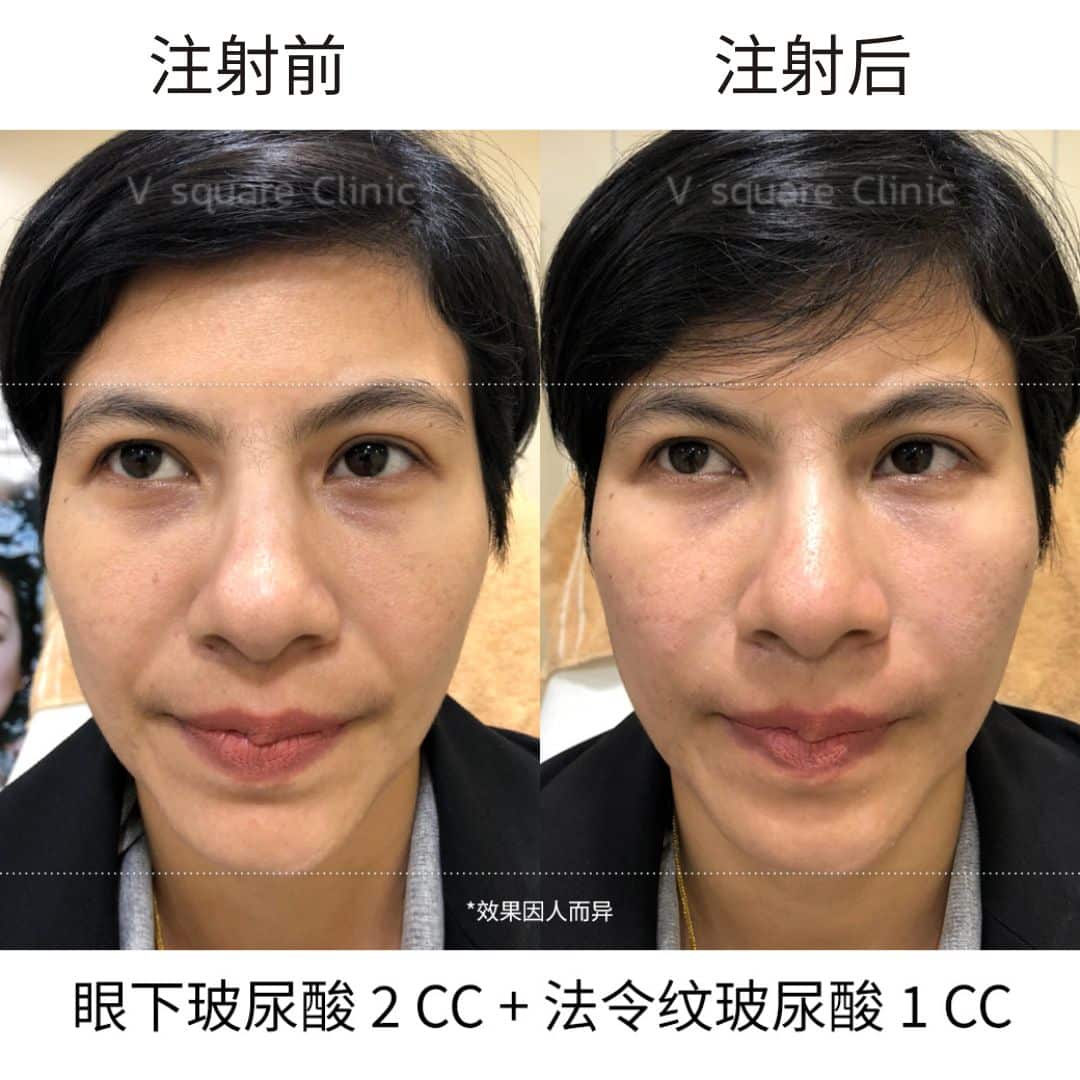 filler review_จอย