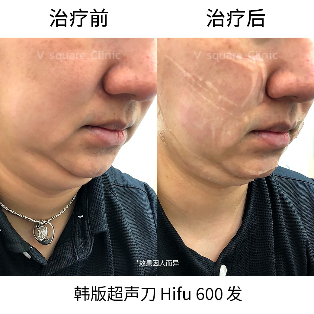 hifu under chin review