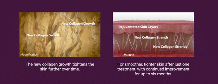 how thermage flx work