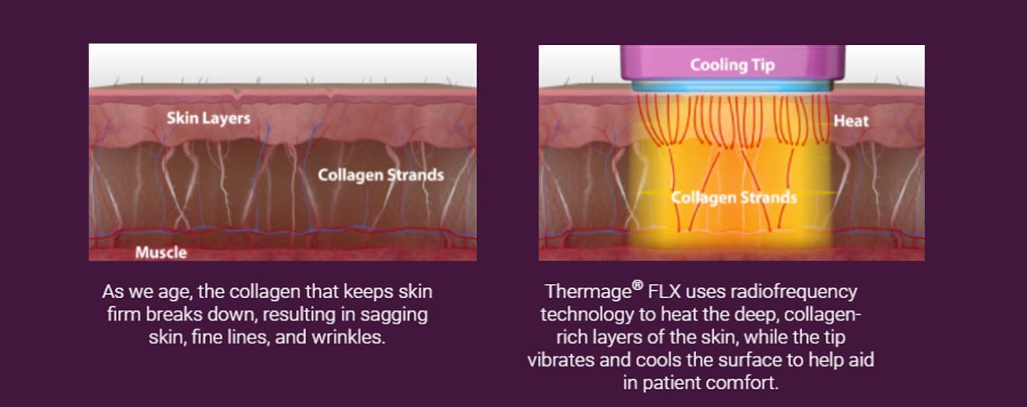 how thermage work