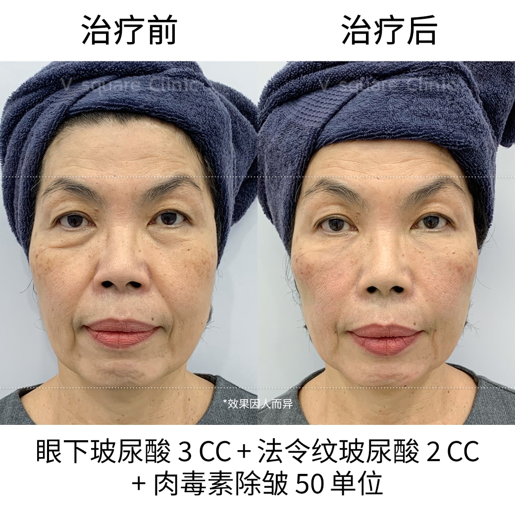 review Botox_คุณนุช