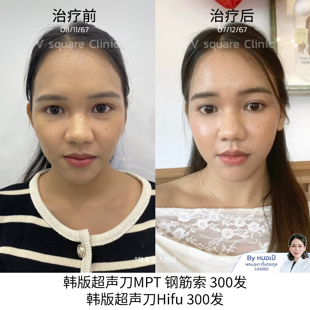 review Hifu_มายด์ (นักกายทำ)