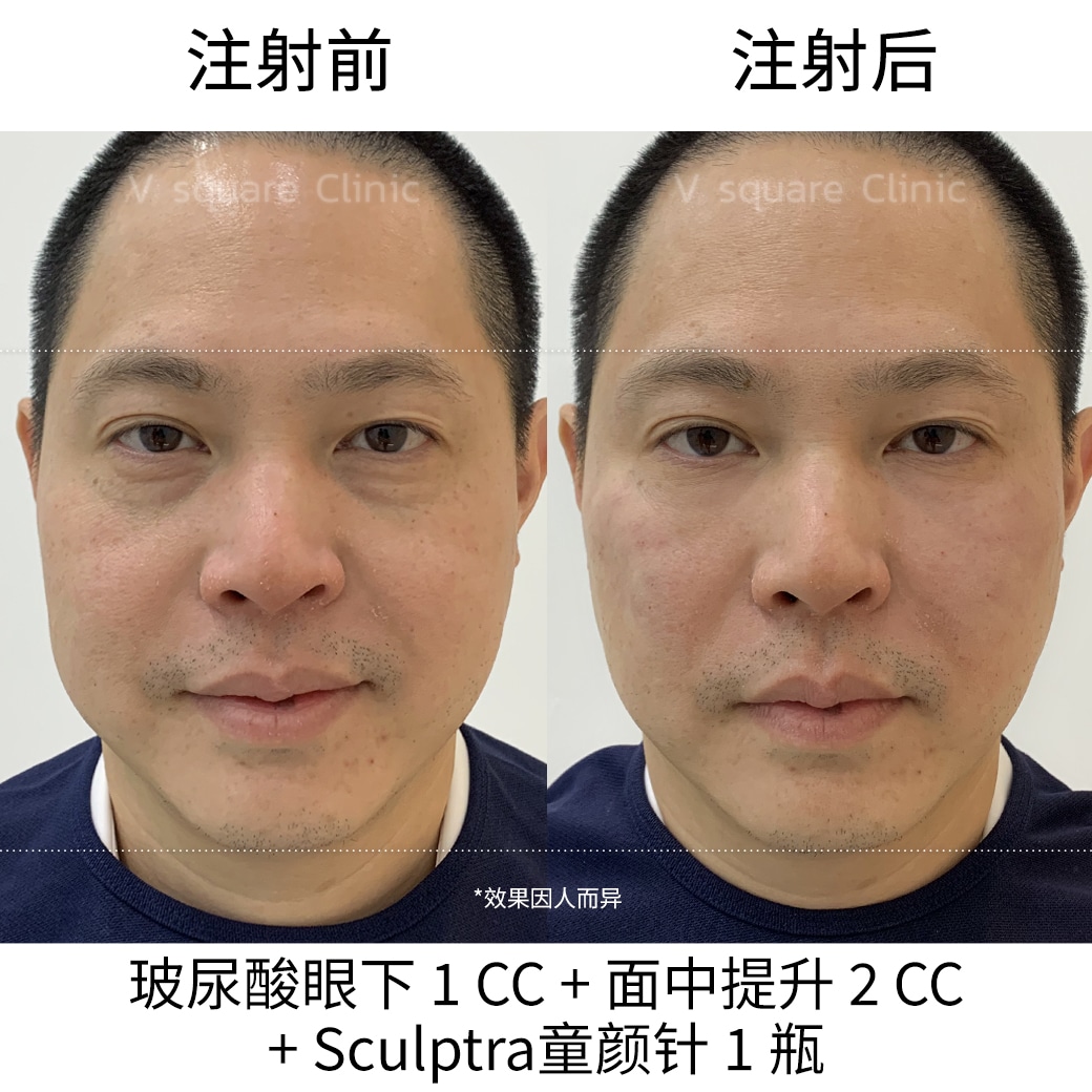 review Sculptra_หมอเส