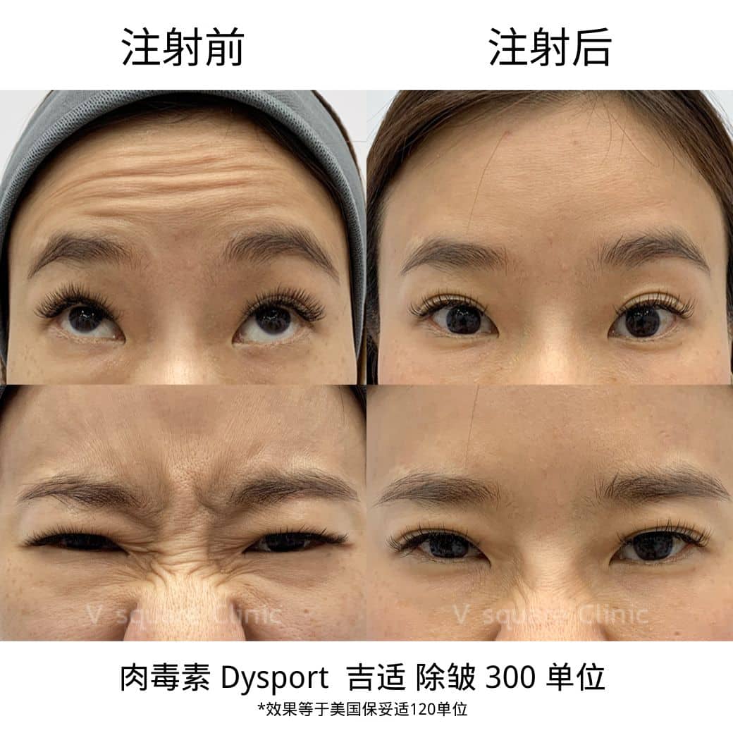 review botox_คุณแสง(Tiktoker)