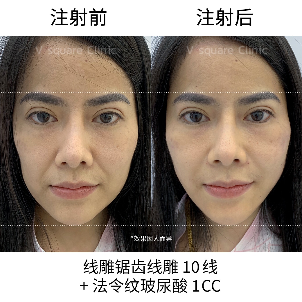 review thread lifting_ลัดดา