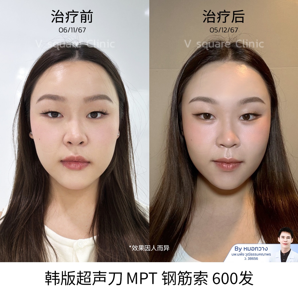 reviewUltraformer MPT_คุณเหวิน