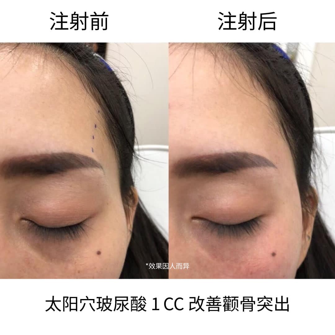 temple filler injection review