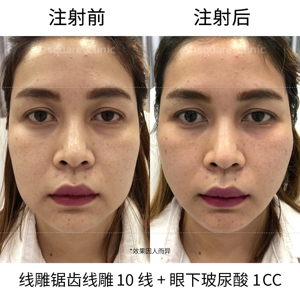 thread lifting Review_R0089