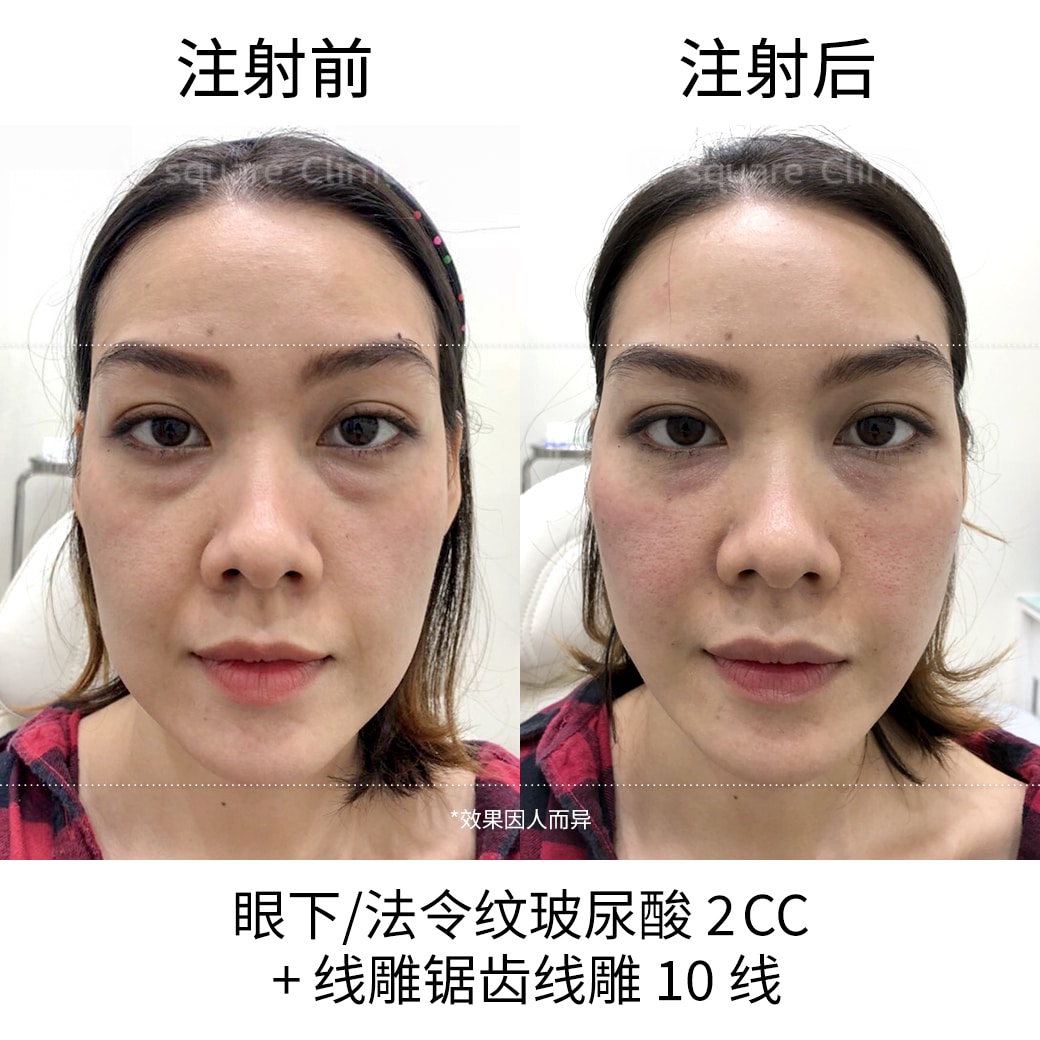 thread lifting Review_แอน