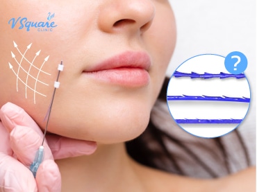 thread lifting 线雕 (埋线) 270x377