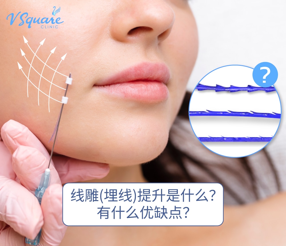 thread lifting 线雕 (埋线)