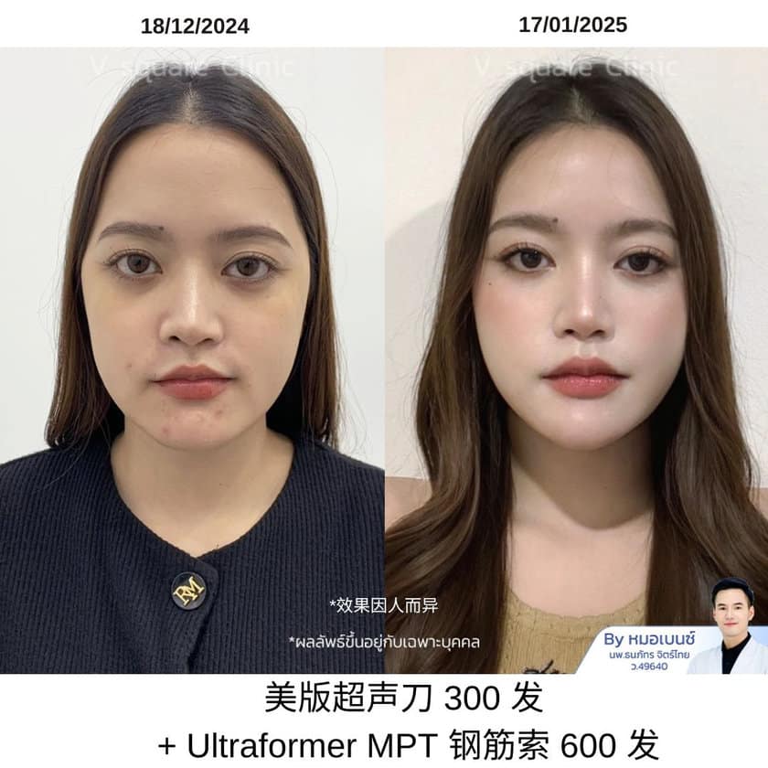 รีวิว Ulthera 300line_คุณเฟรนด์ UL SPT+MPT