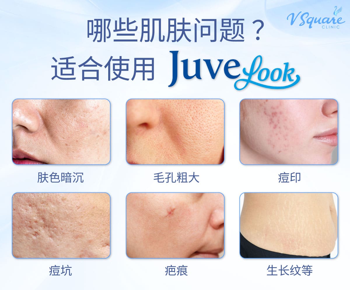 Juvelook best candidiate