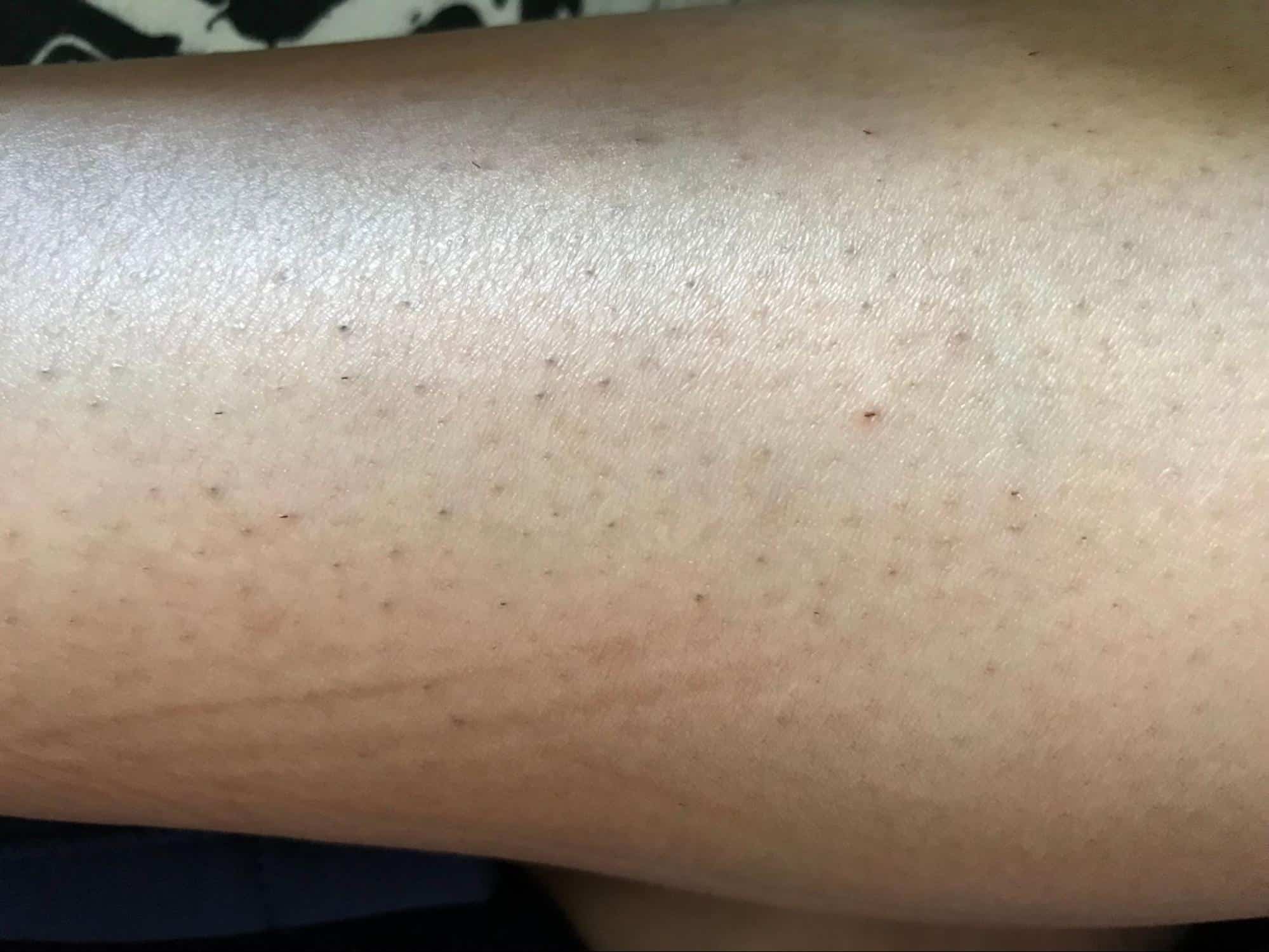 Keratosis Pilaris