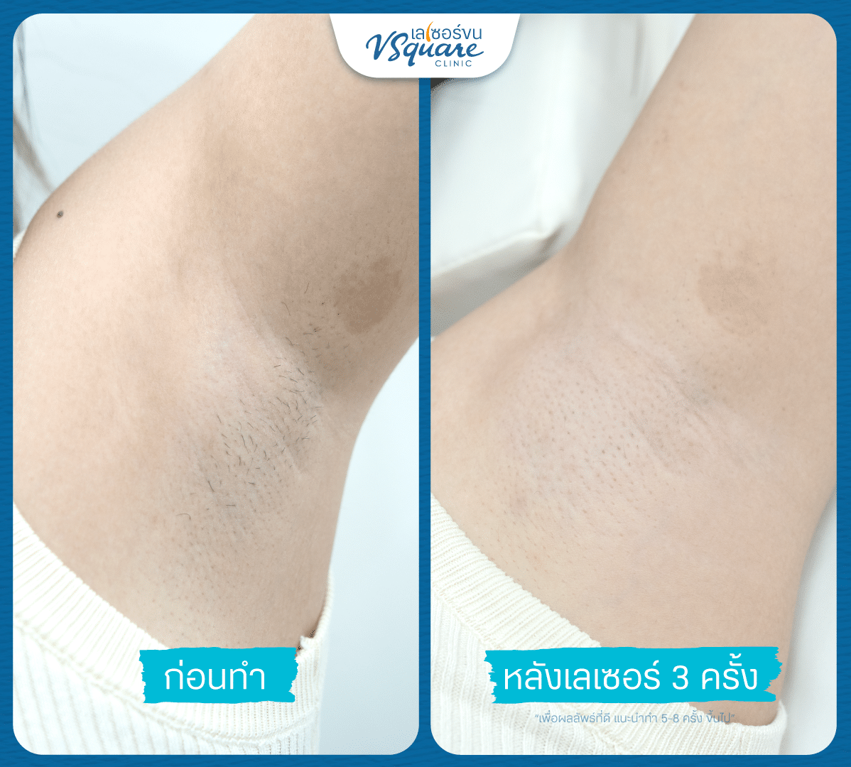 laser armpit hair removal review