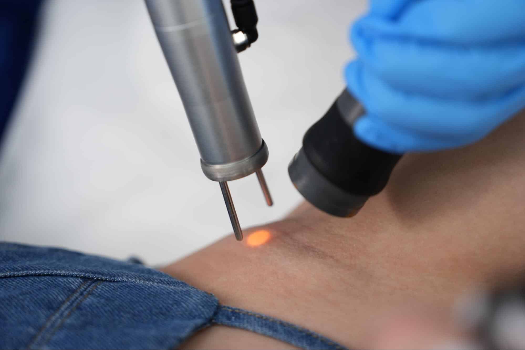 laser armpit hair removal