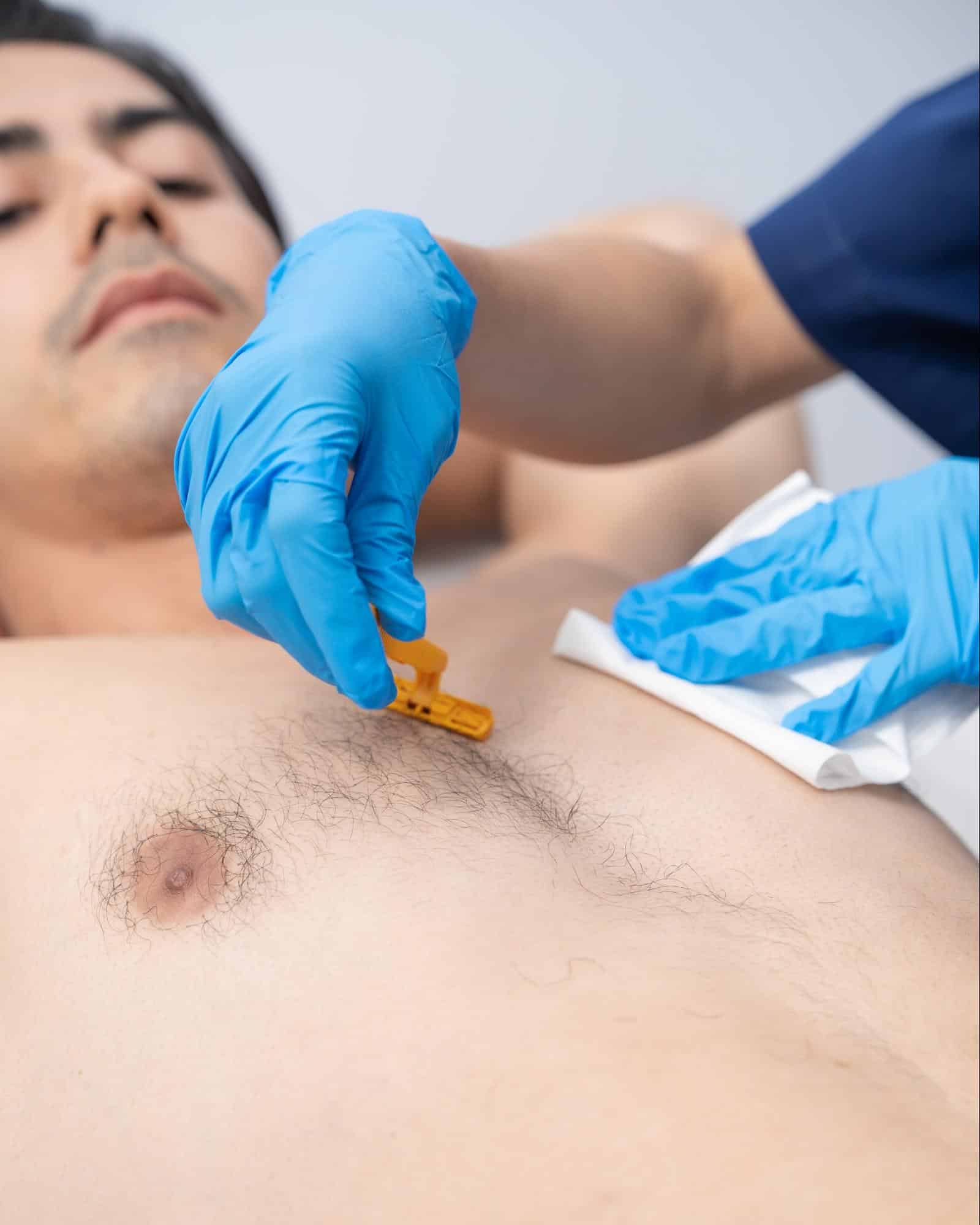 laser chest hair removal