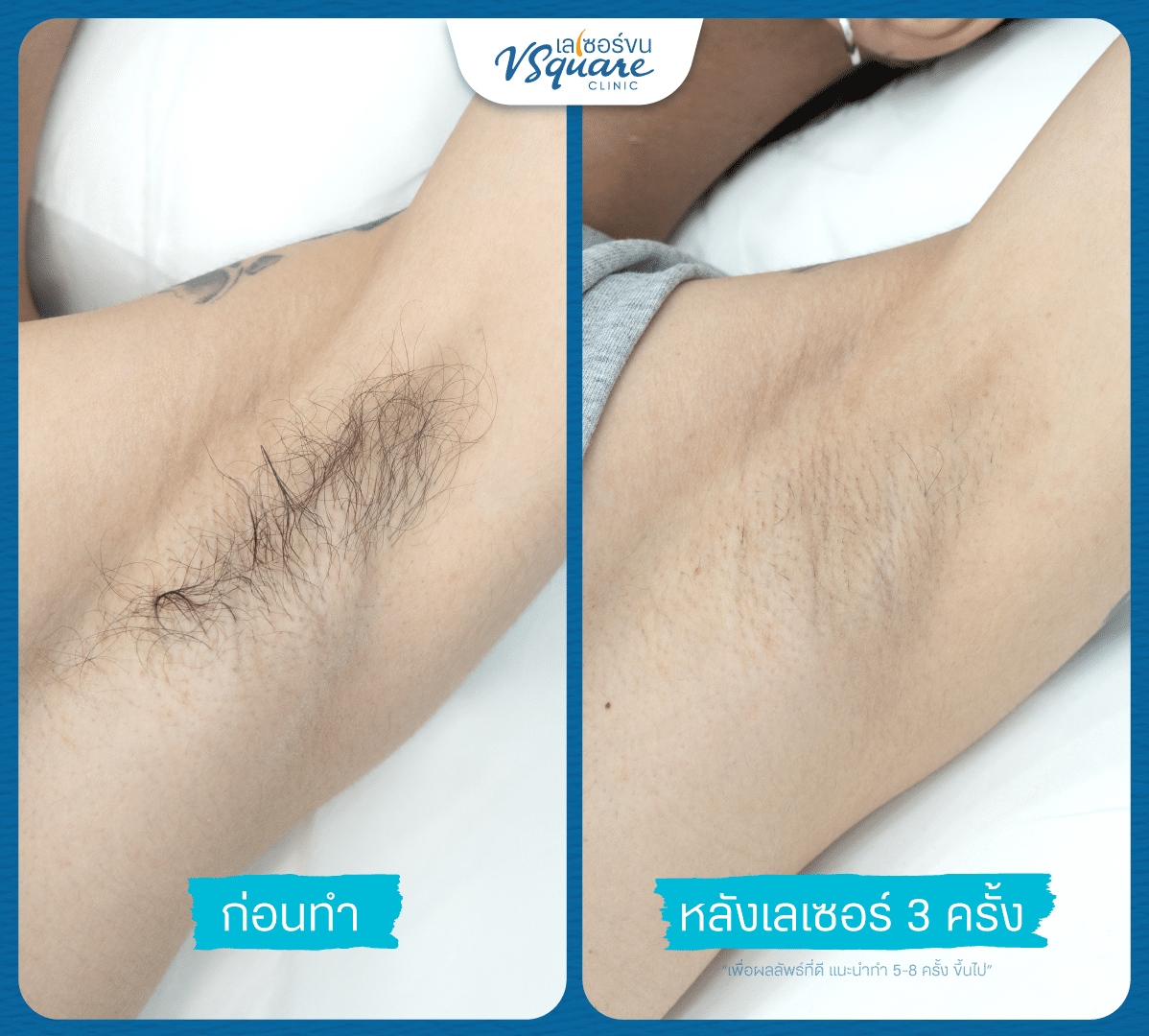 laser hair removal on armpit review