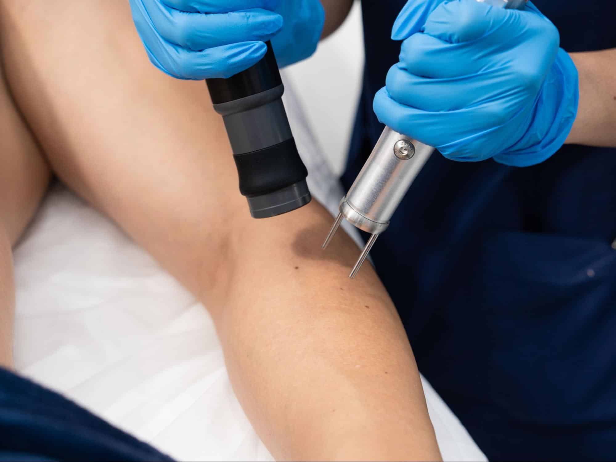 laser hair removal on arms