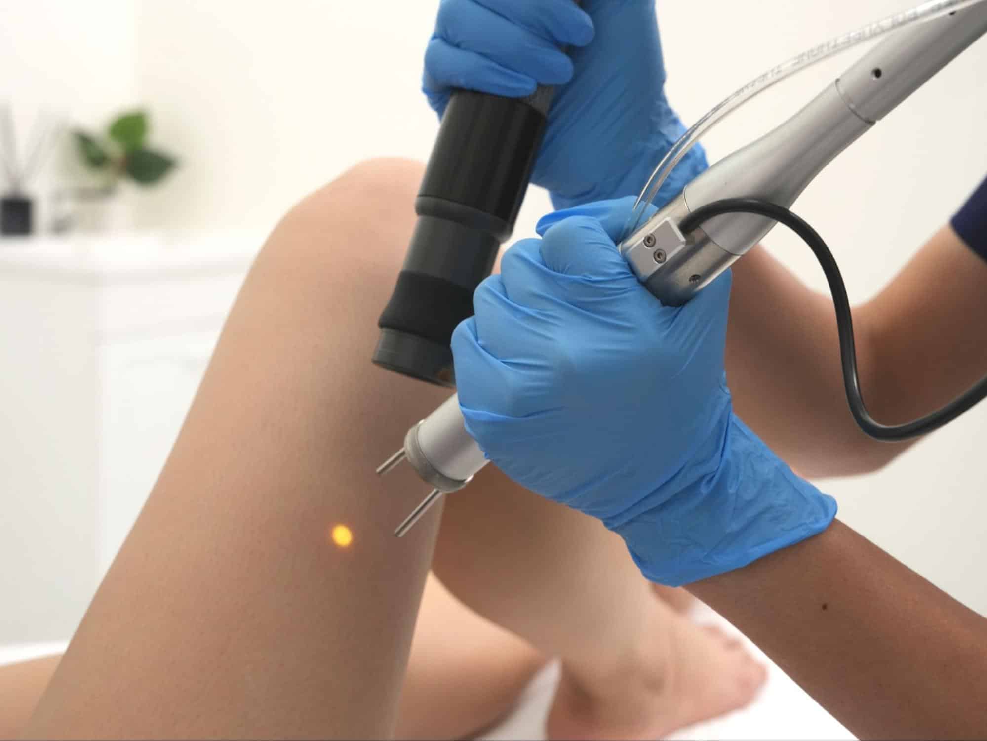 laser hair removal on legs