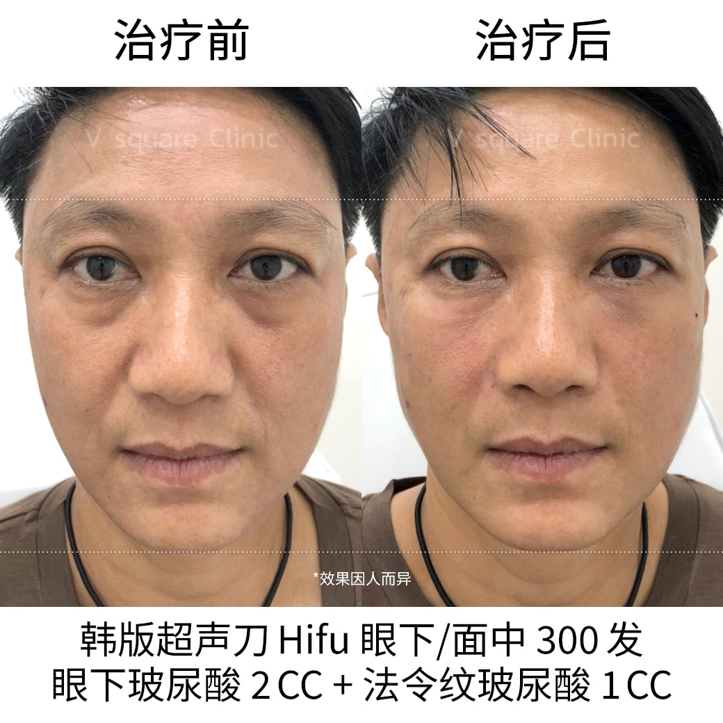 review Ultraformer III under eye