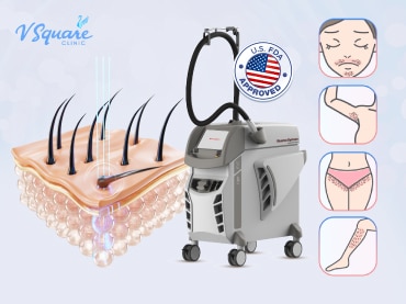 永久激光脱毛 Laser Hair Removal -370x277
