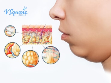 Meso Fat injection 美塑溶脂 370x277