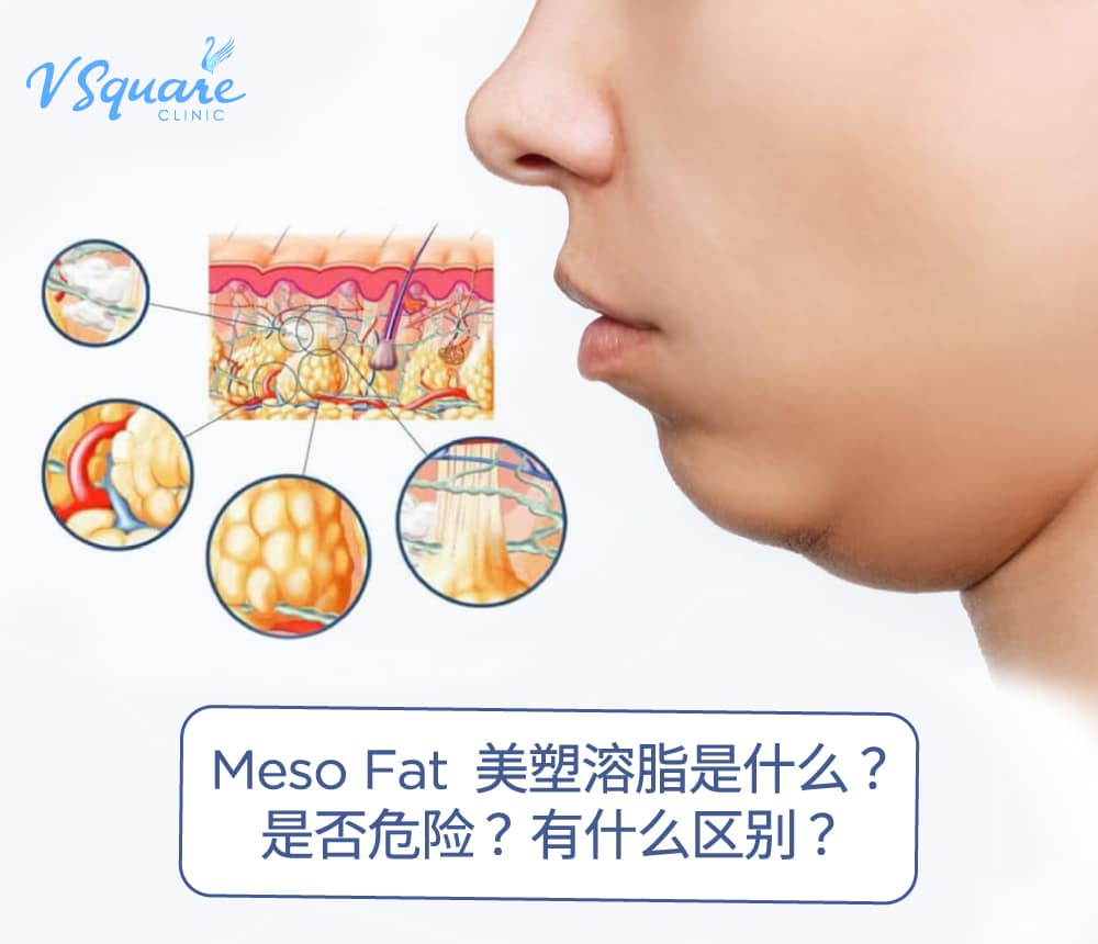Meso Fat injection 美塑溶脂