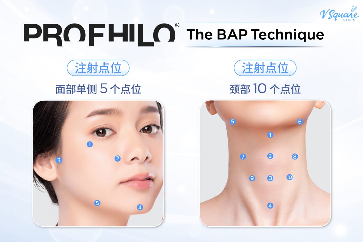 Profhilo BAP Technique