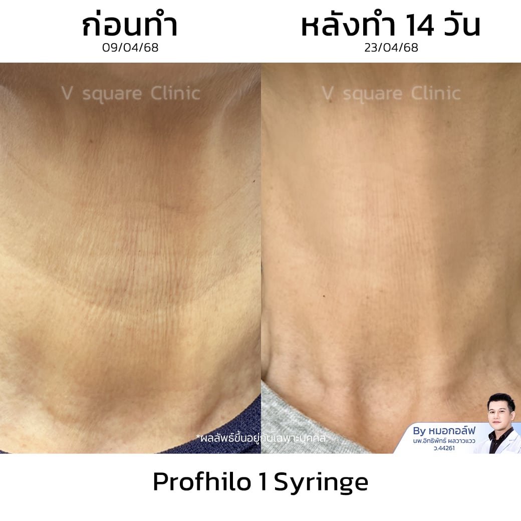 Profhilo Review_พี่ต่าย โดย หมอกอล์ฟ