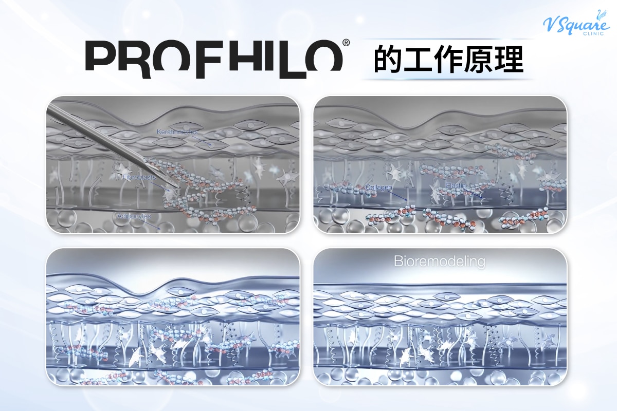 Profhilo how it works