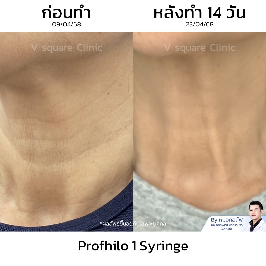 Profhilo neck review_พี่ต่าย โดย หมอ กอล์ฟ