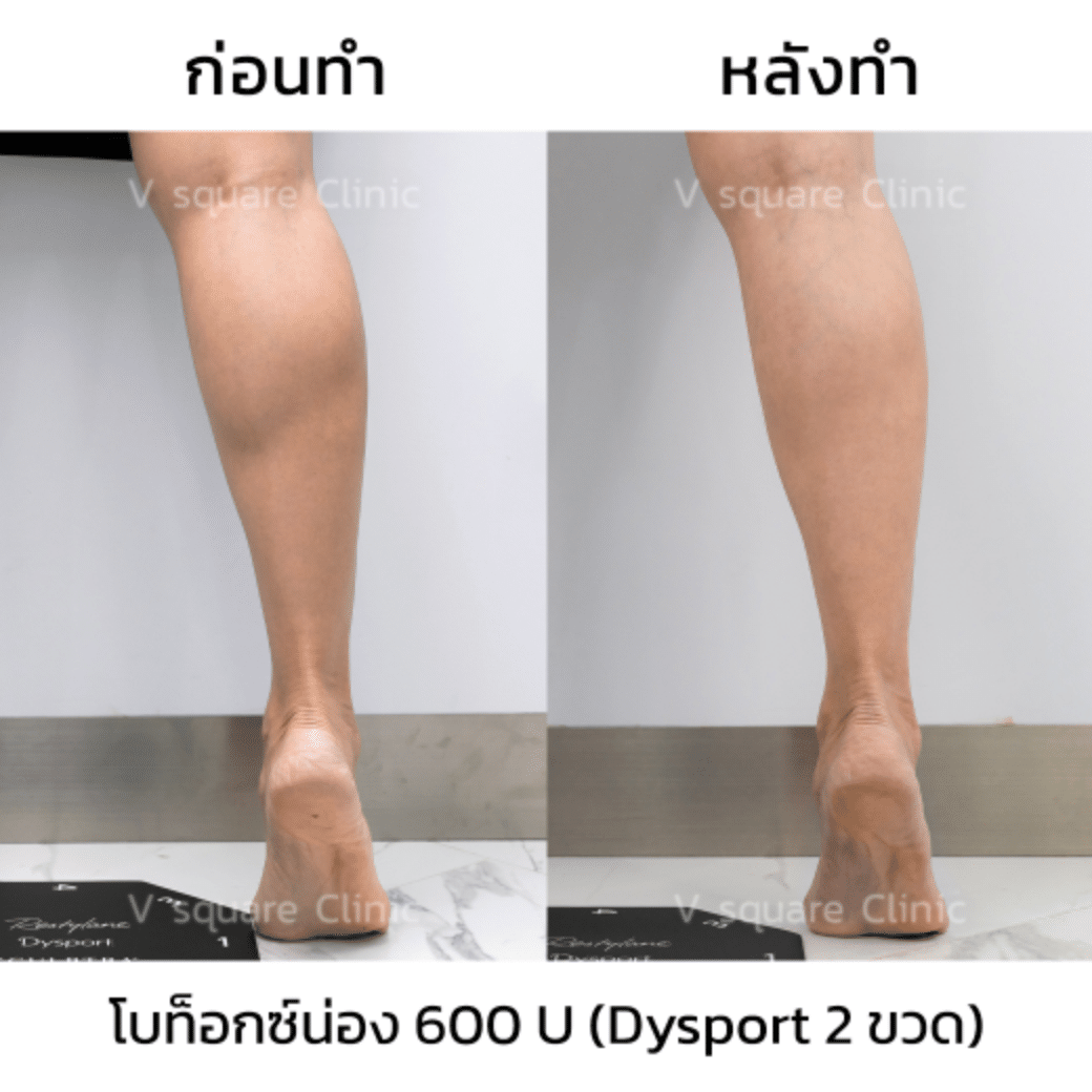 botox calf muscle review_คุณแจน